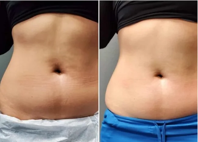 Abdomen, front view — after a course of Anthéa body sessions