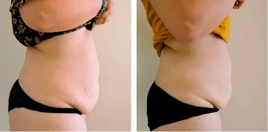 Abdomen and waist, side profile — after a course of Anthéa body sessions
