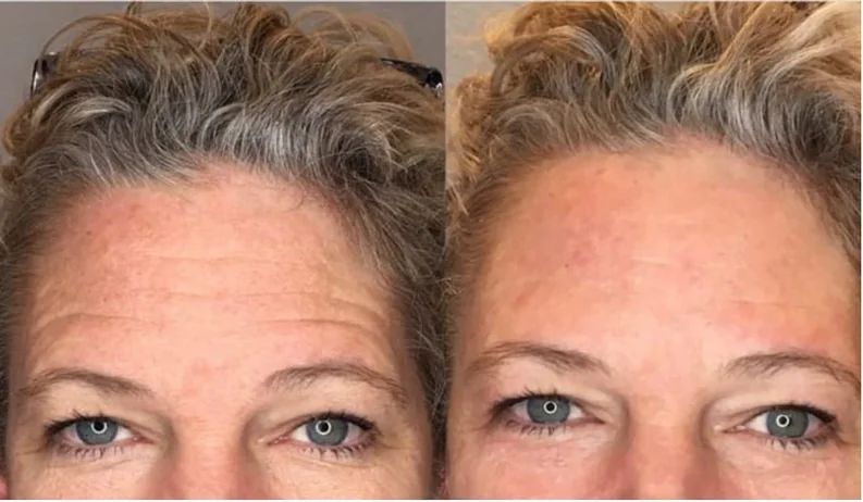 Eye contour and forehead — after a course of Anthéa face sessions with the curved handpiece