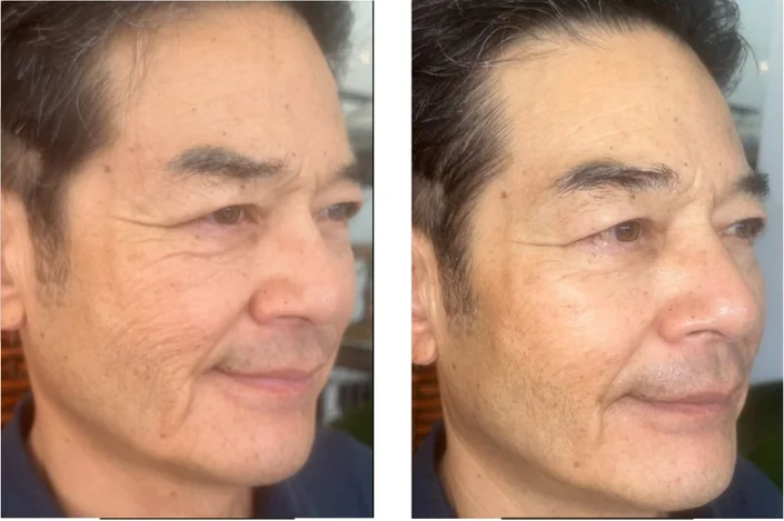 Cheek and jawline, male client — after a course of Anthéa face sessions