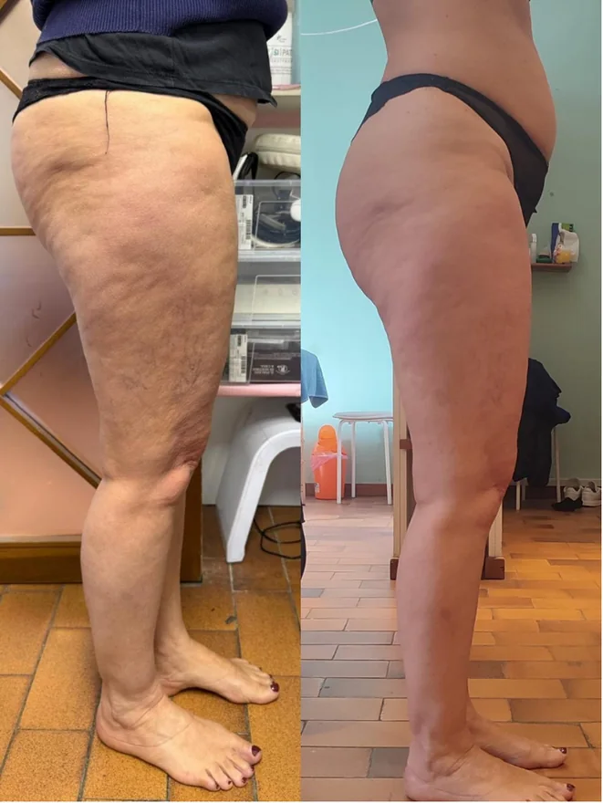 Legs, side view — after a course of Anthéa leg and glute sessions