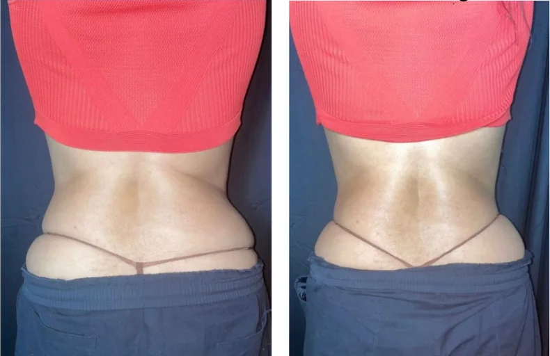 Lower back and waistline — after a course of Anthéa body sessions