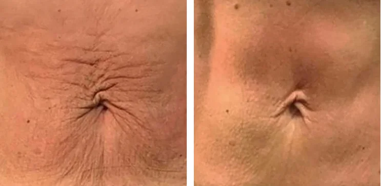 Abdominal skin around the navel — after a course of Anthéa skin sessions