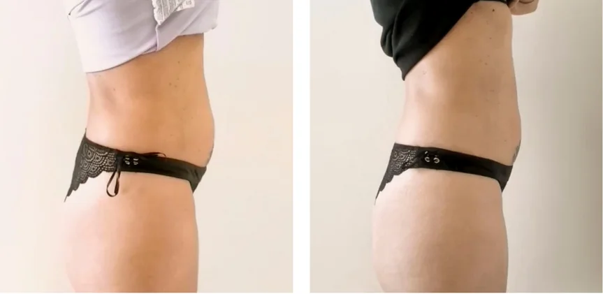 Waist, side profile — after a course of Anthéa body sessions