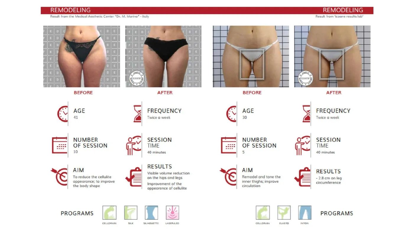 icoone® before and after — appearance of cellulite, with age, frequency, session count and session time