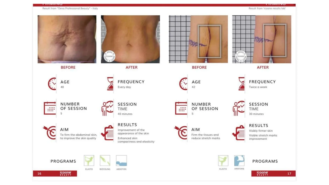 icoone® before and after — body firming, with session data