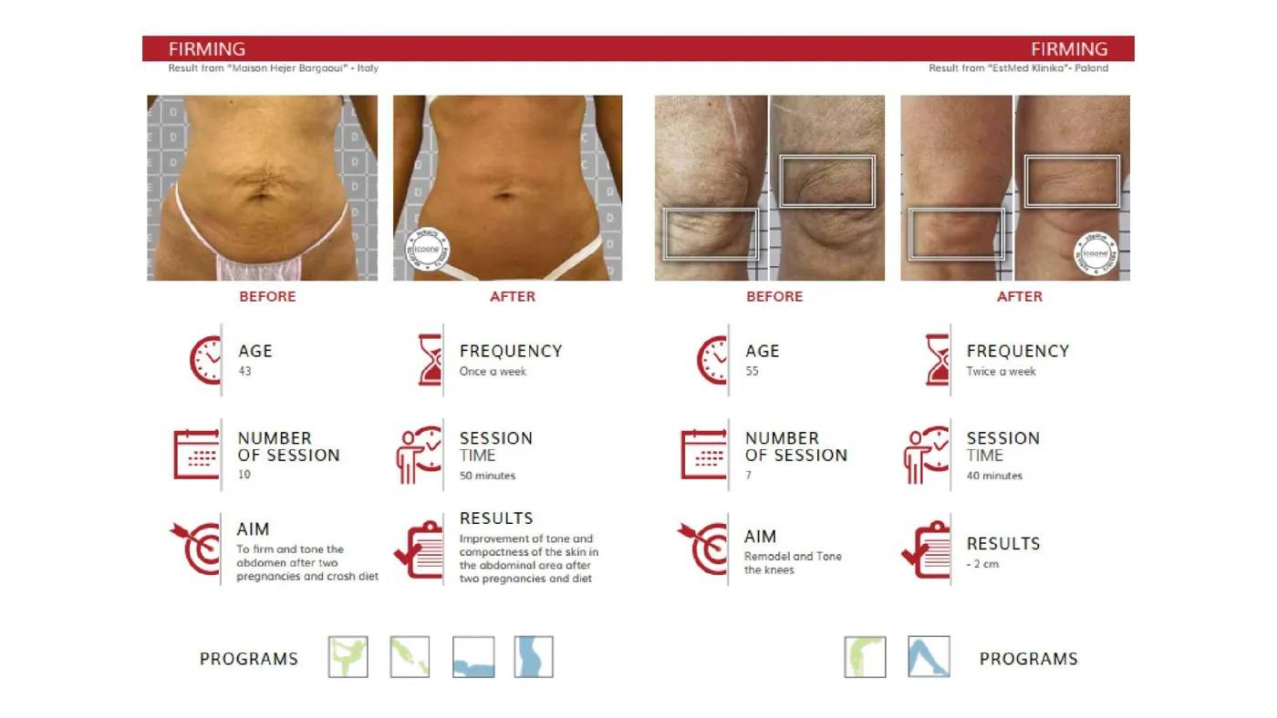 icoone® before and after — body remodelling, second documented case