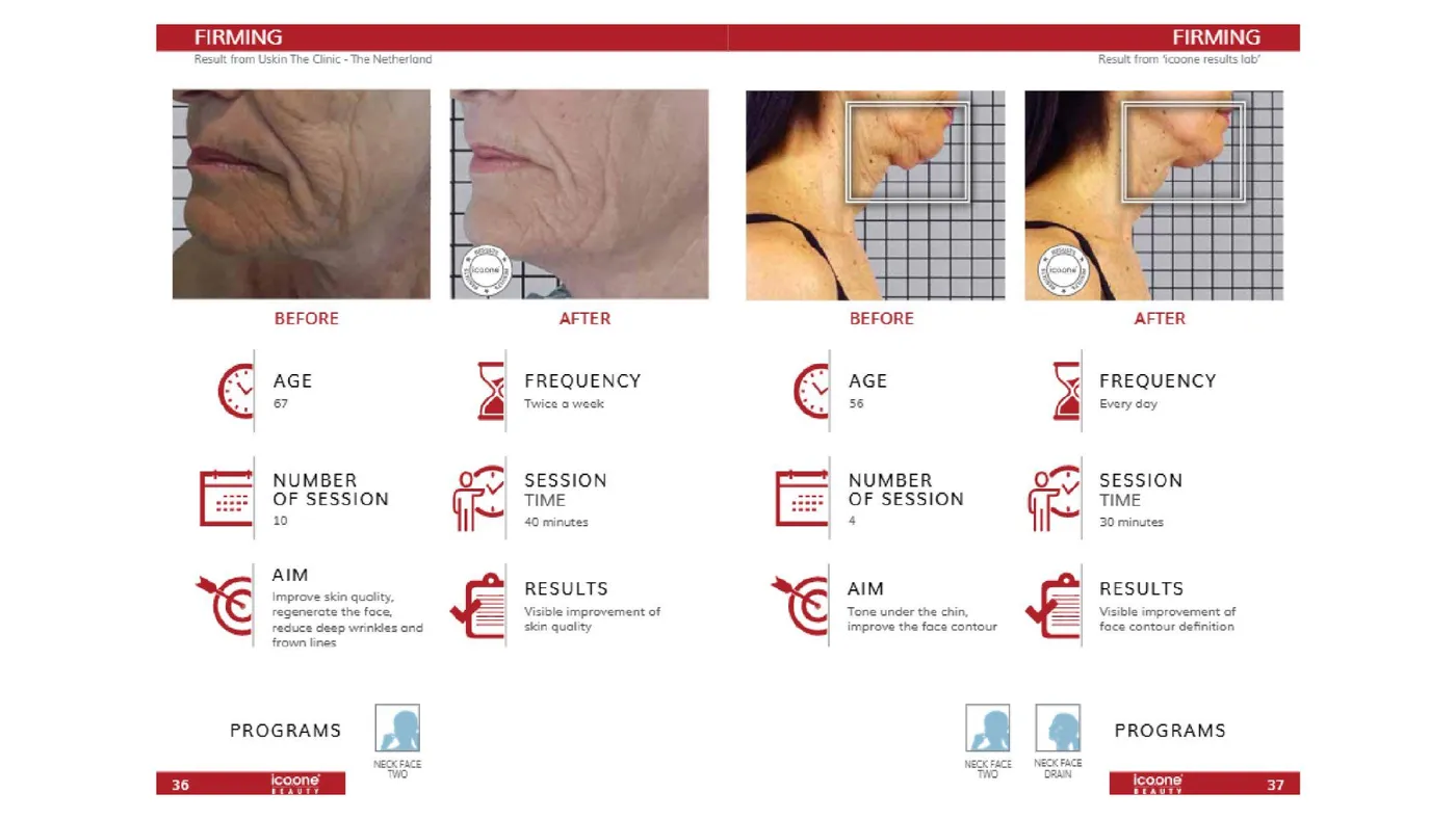 icoone® before and after — face and neck firming with session data