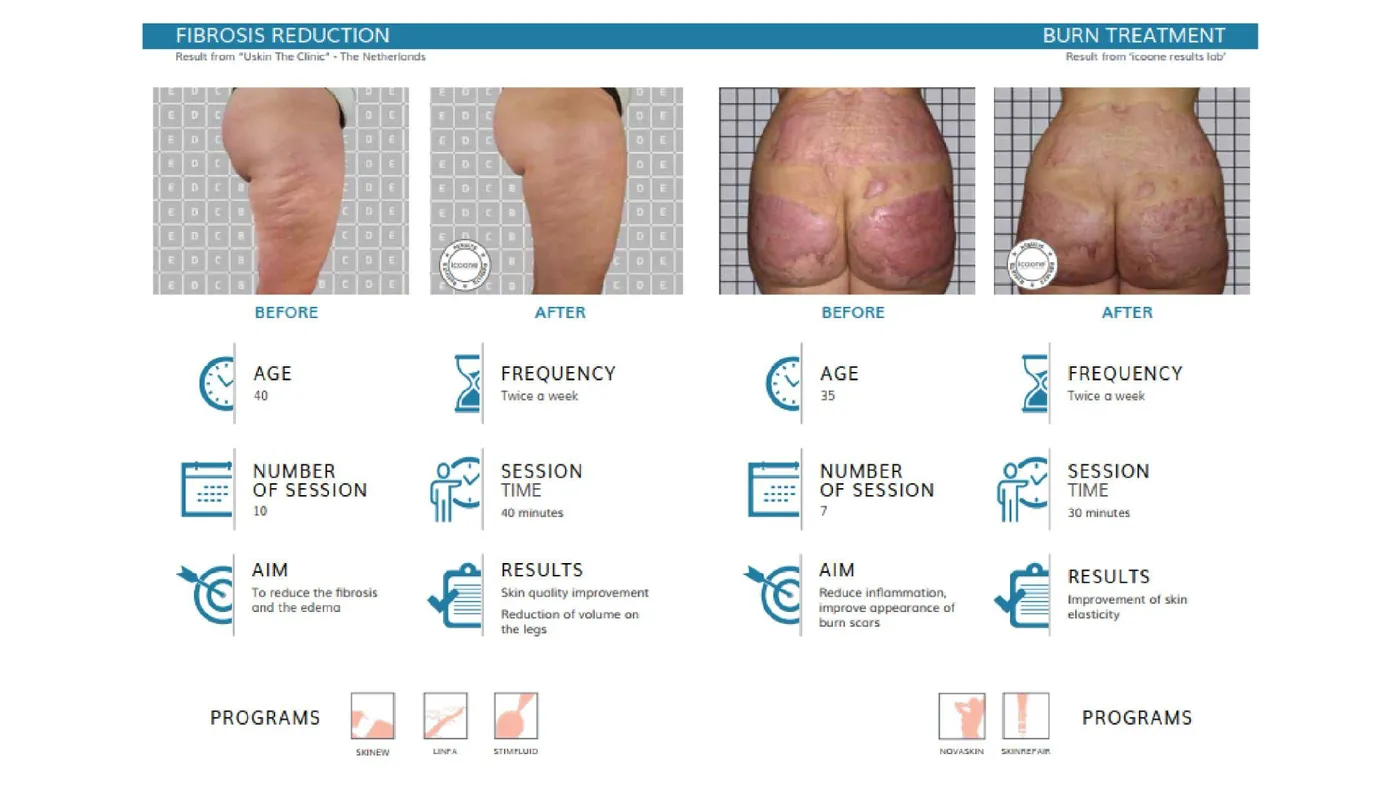 icoone® documented cases — fibrosis and burn scars, international