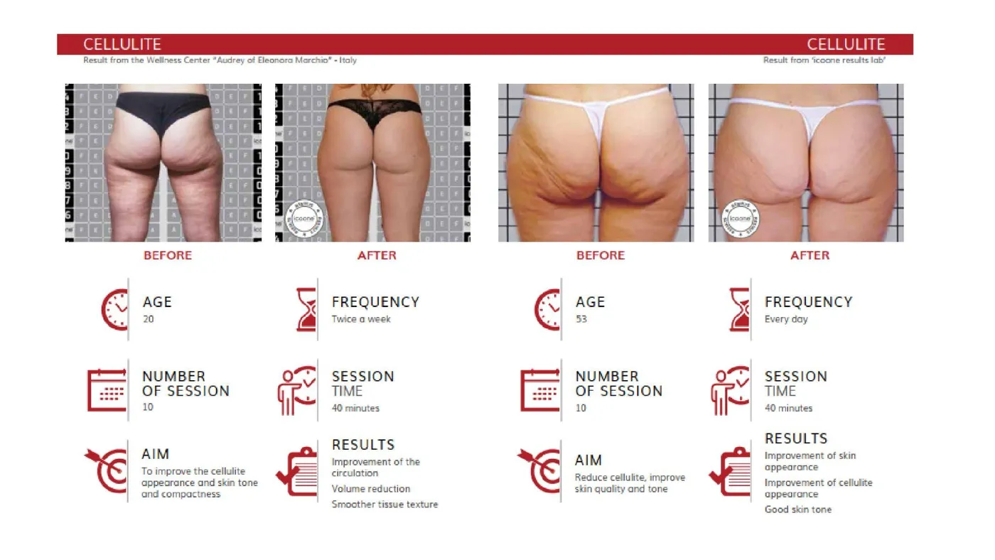 icoone® body session — robotic microstimulation platform by i-Tech Industries
